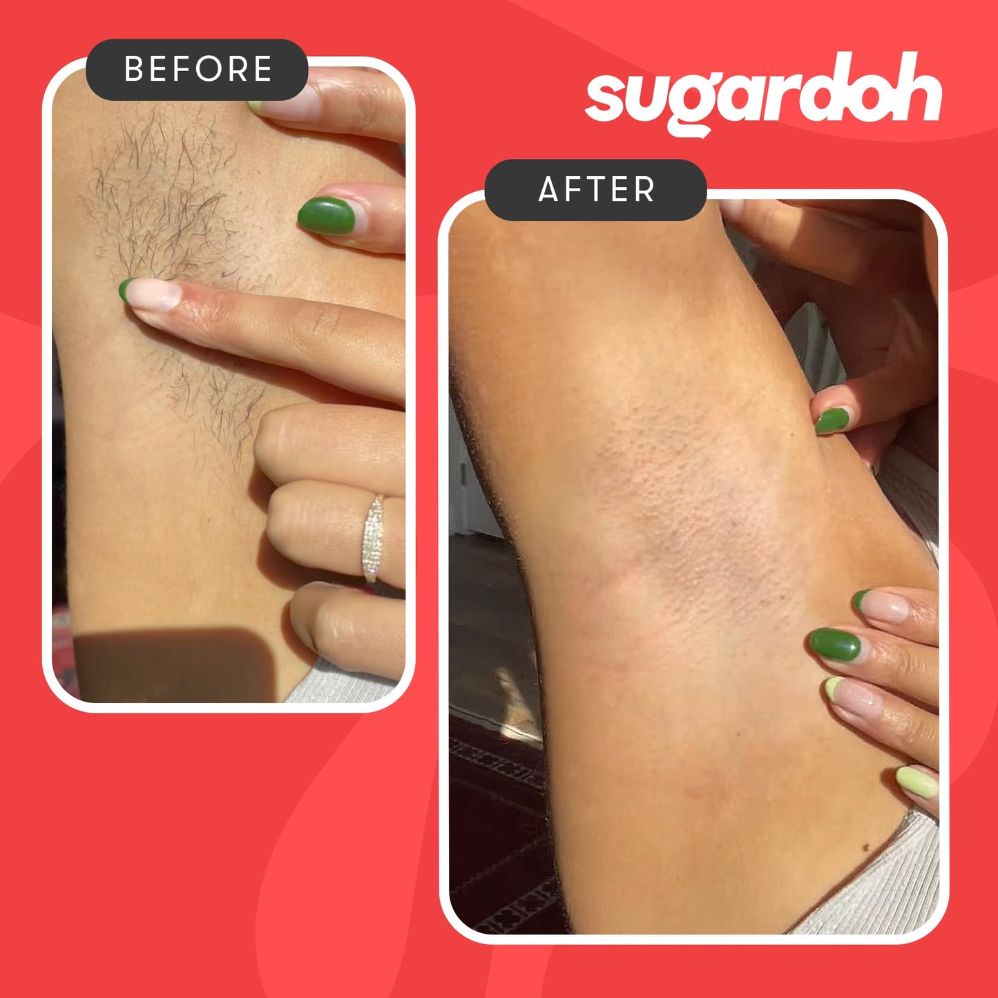 Sugardoh 女士蜜蜡脱毛套装，如 Shark Tank 所示（迷你套装）面部、手臂和腿部蜜蜡脱毛 - 蜜蜡脱毛 Tiktok 热门产品 - 女士比基尼蜜蜡脱毛套装 - 蜜蜡脱毛套装