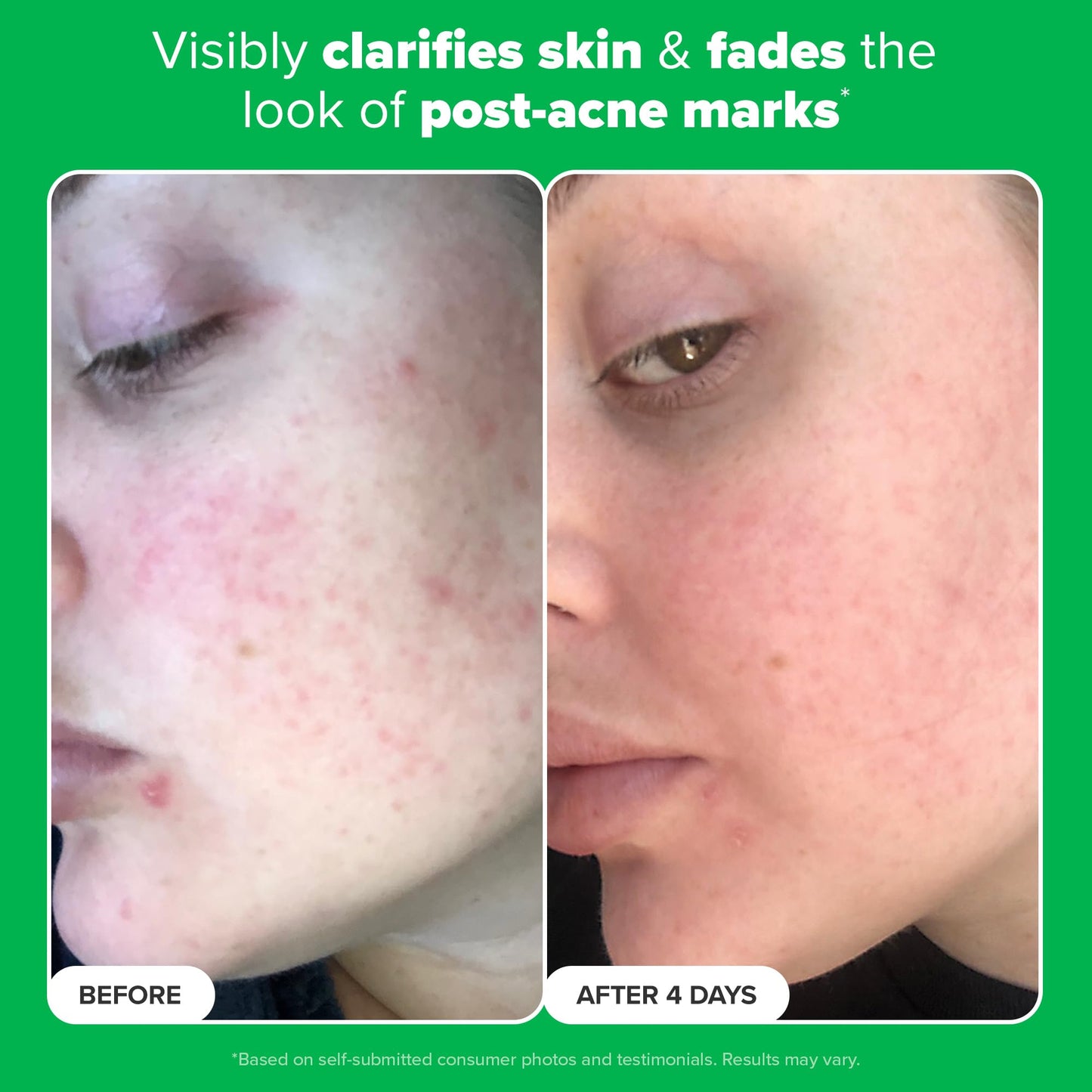 Paula's Choice BOOST 10% 壬二酸增强霜凝胶，甘草提取物和水杨酸，无油亮肤精华，1 盎司