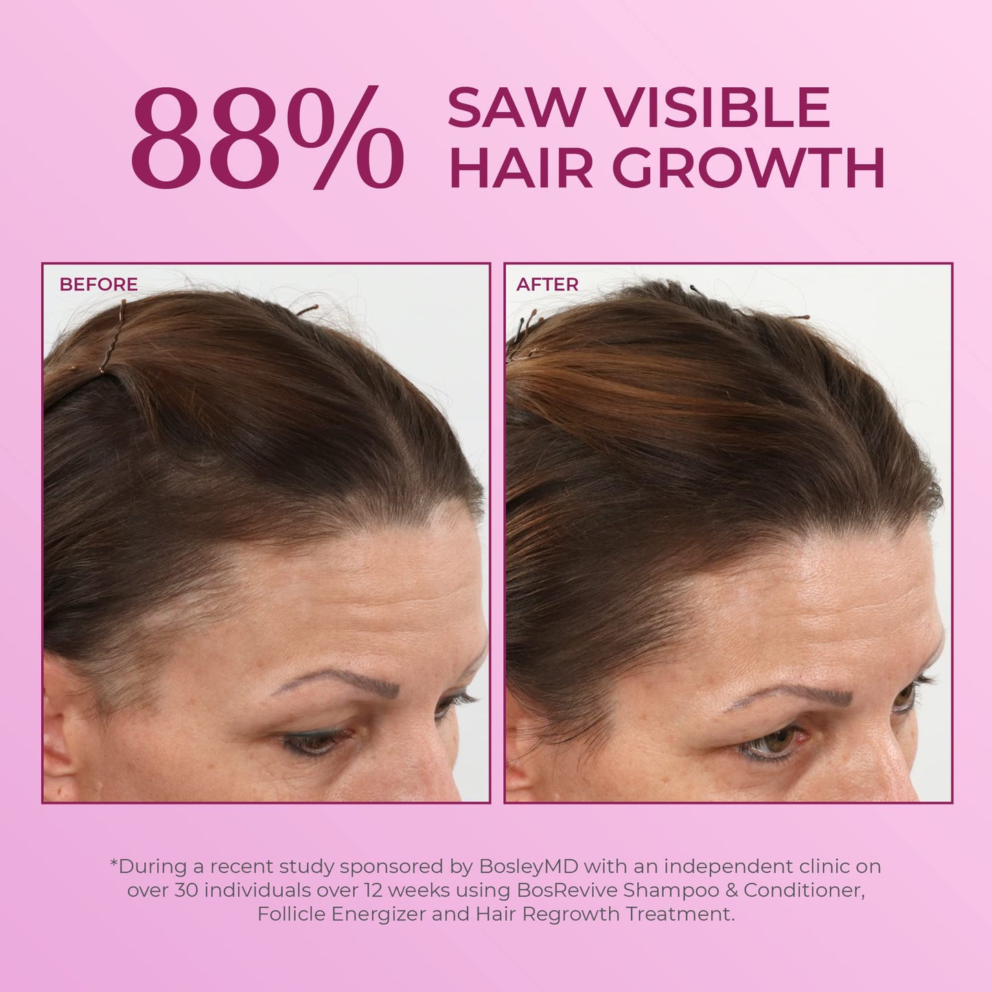 Misty Rose BosleyMD Minoxidil 2% Hair Regrowth Treatment for Women, Clinically Proven Hair Growth Solution for Thinning Hair & Female Pattern Hair Loss - Topical Scalp Treatment – 2 x 2 Fl Oz (2 Month Supply)