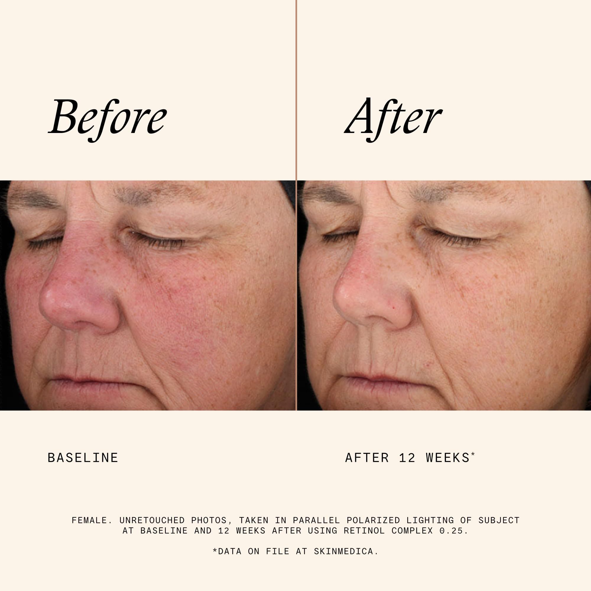 SkinMedica Retinol 0.25 Complex - Retinol Serum for Face, Age-Defying Advanced Retinol Cream That Renews Skin and Diminishes the Appearance of Fine Lines and Wrinkles, 1 Fl Oz