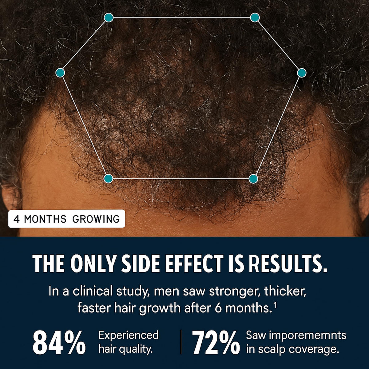 Hairfol Men's Hair Growth Supplement – Clinically Tested Hair Growth V ...