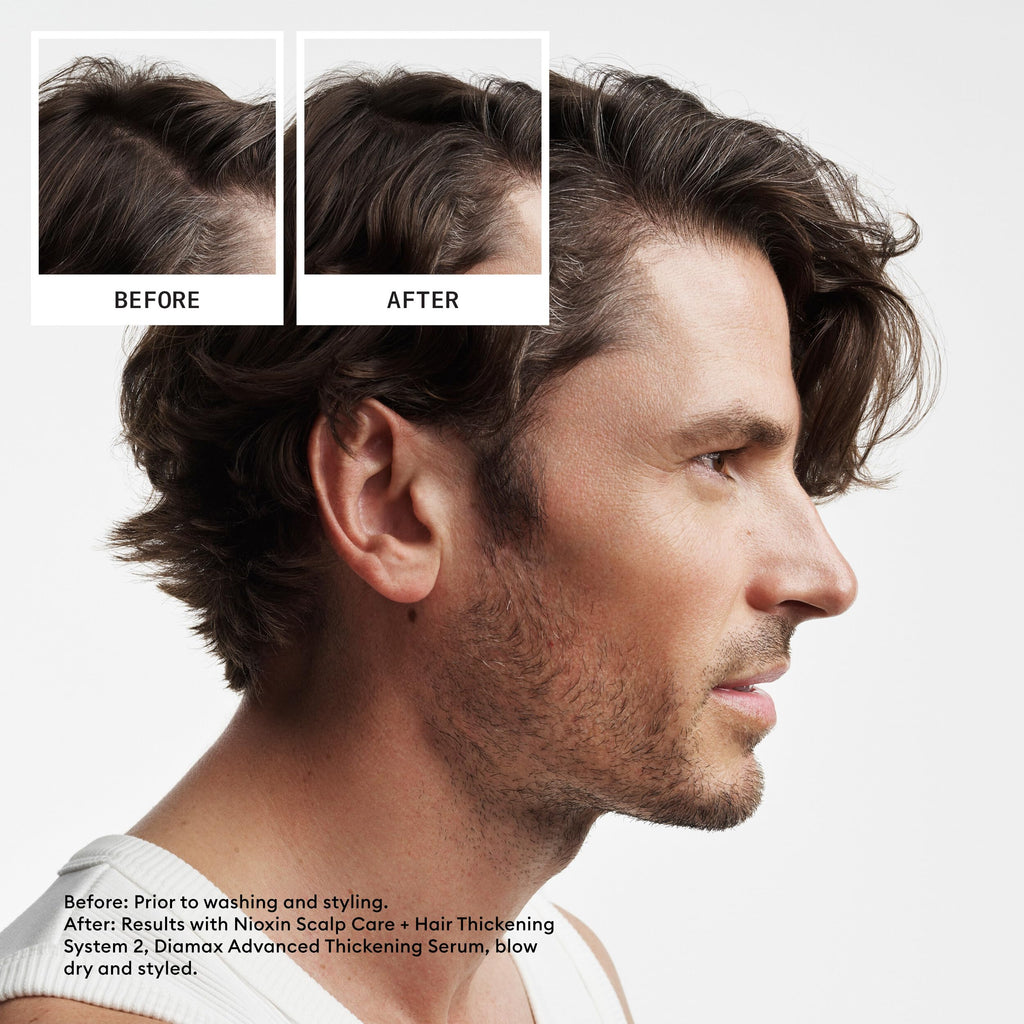 Nioxin Scalp + Hair Thickening System 2 | For Natural or Untreated Hair with Progressed Thinning| Full Size| 3 Month Supply