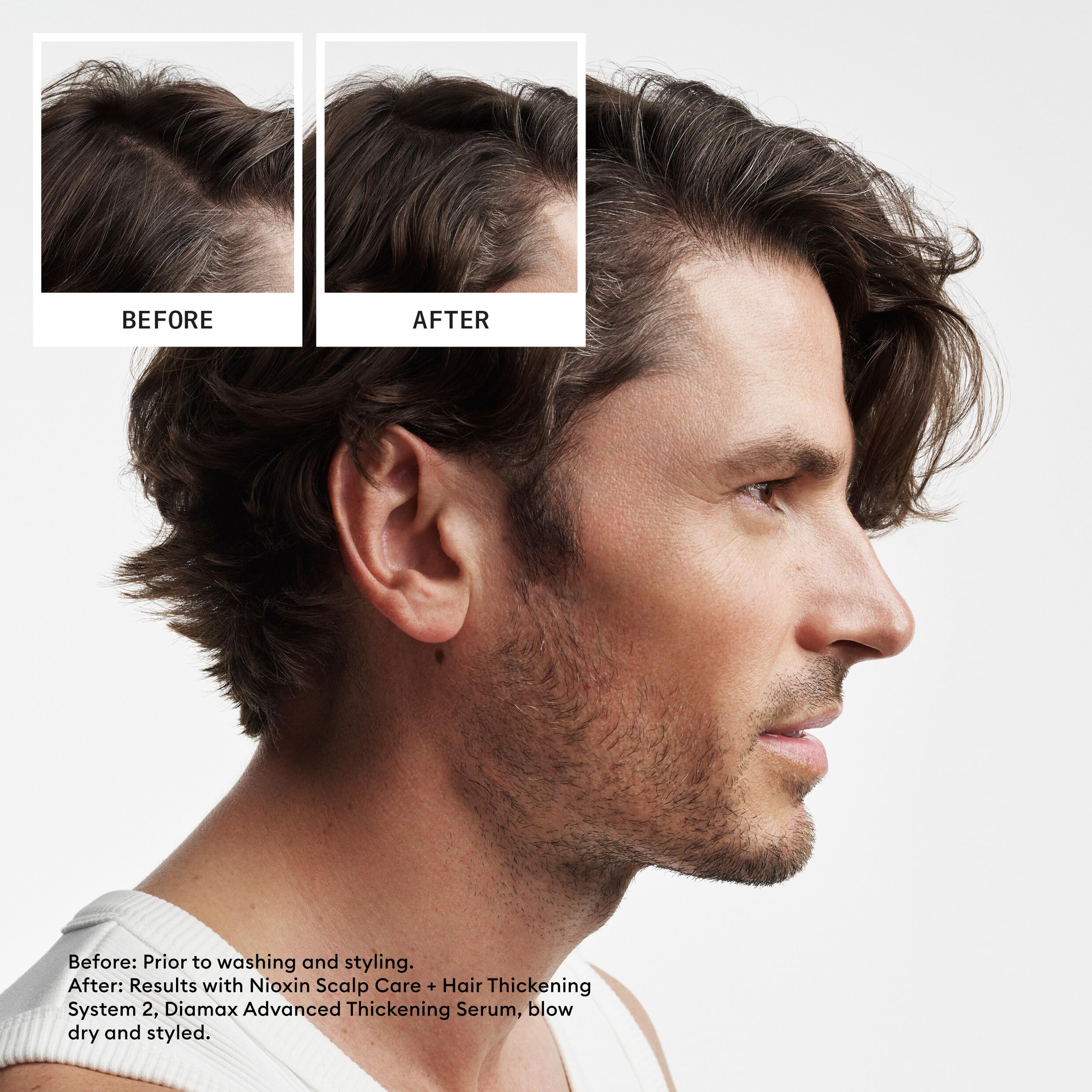 Nioxin Scalp + Hair Thickening System 2 | For Natural or Untreated Hair with Progressed Thinning| Full Size| 3 Month Supply